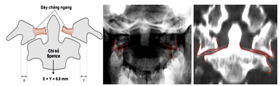 Mô tả cách tính chỉ số Spence