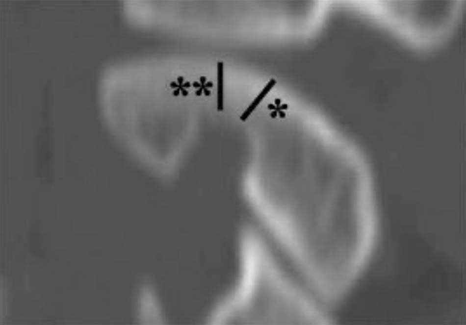 Chiều cao eo (dấu hoa thị đơn) và chiều cao trong (dấu hoa thị đôi) đốt sống C2 [64].