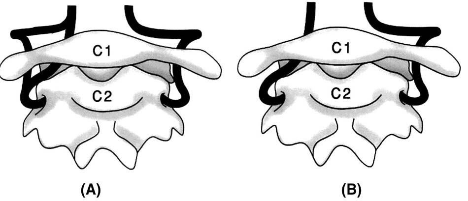 Minh họa ĐMĐS chẽ đôi và tồn lưu ĐM chẩm đội bào thai