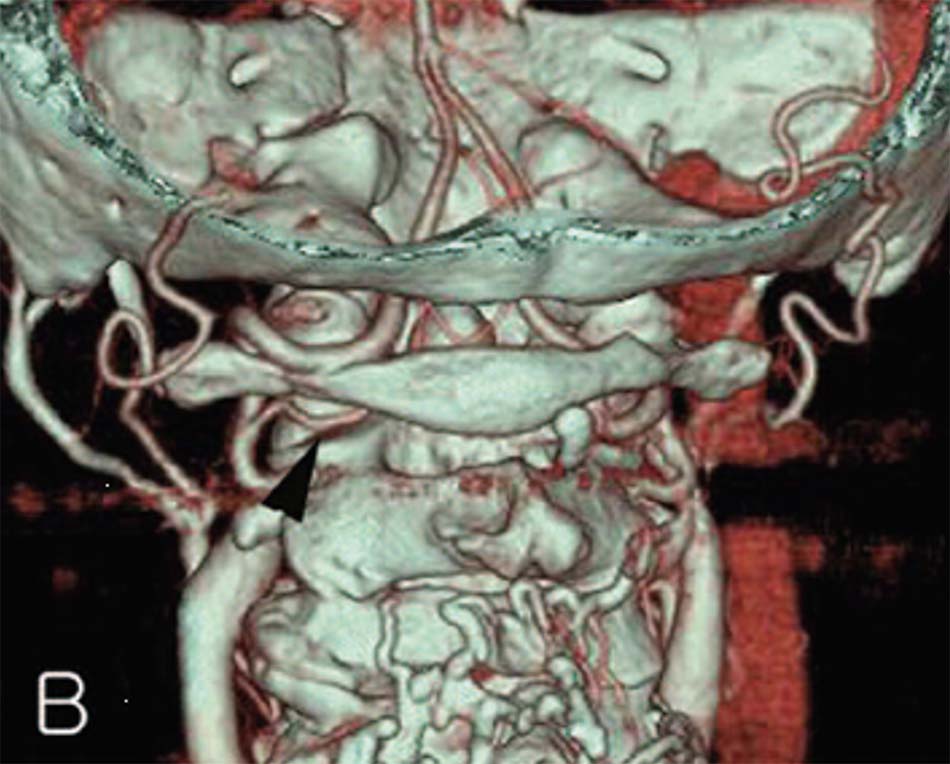 CLVT dựng hình 3D bất thường ĐM tiểu não sau dưới xuất phát sớm (mũi tên đen)