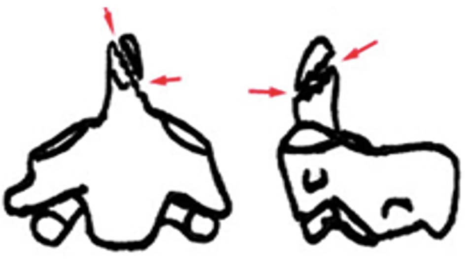 Gãy mỏm nha loại 1.