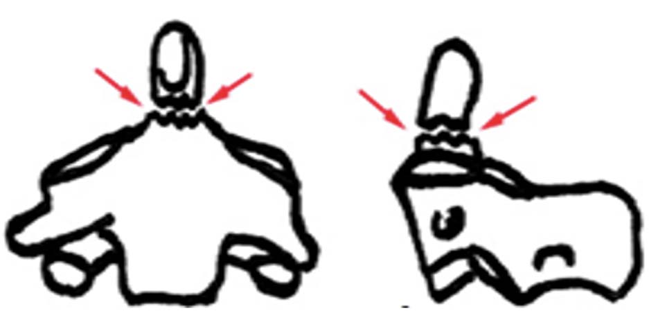 Gãy mỏm nha loại 2