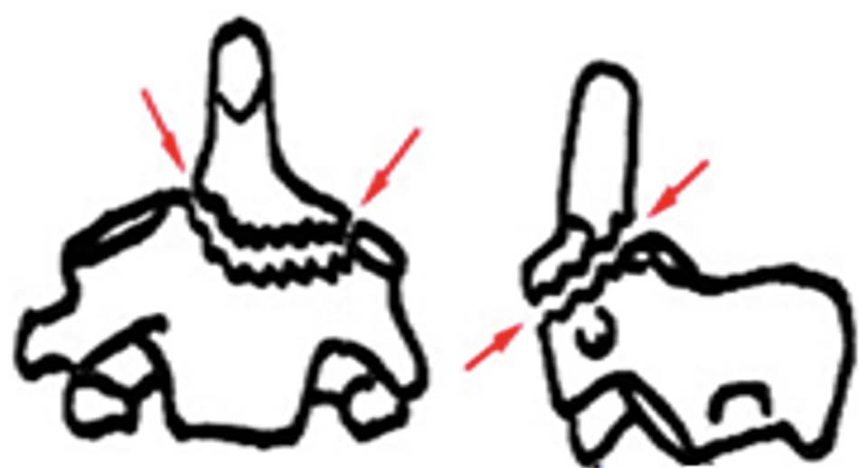 Gãy mỏm nha loại 3