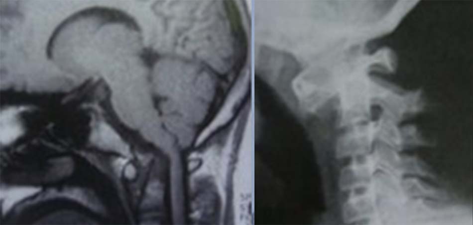 Giãn dây chằng ngang đốt đội (hội chứng Down)