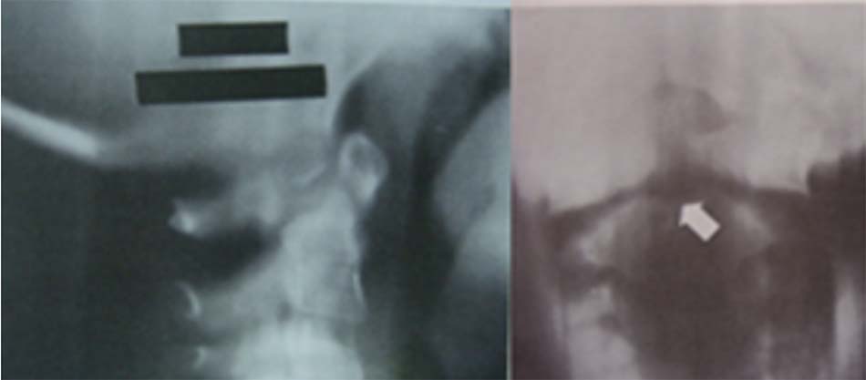 Hình ảnh Xquang không có mỏm nha.