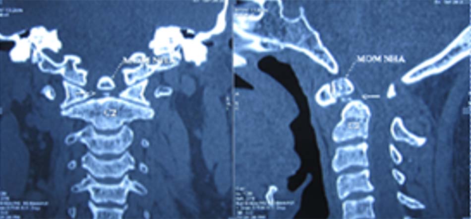 Khớp giả mỏm nha trên cắt lớp vi tính (hội chứng Down)