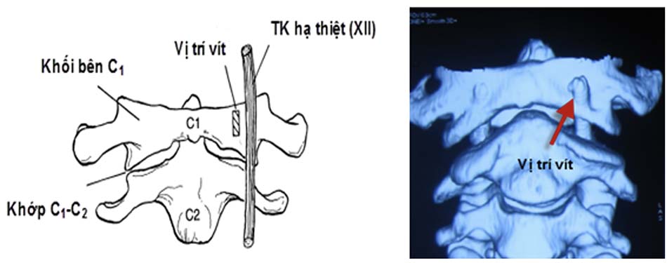 Liên quan vị trí vít và Thần kinh XII