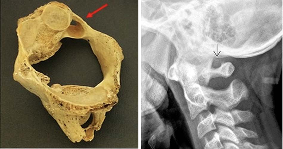 Lỗ cung C1: nhìn nghiêng trên bệnh phẩm xương khô và trên phim XQ cột sống cổ nghiêng