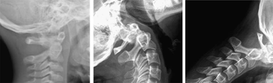 Mất vững C1-C2, khớp giả mỏm nha trên Xquang thường quy
