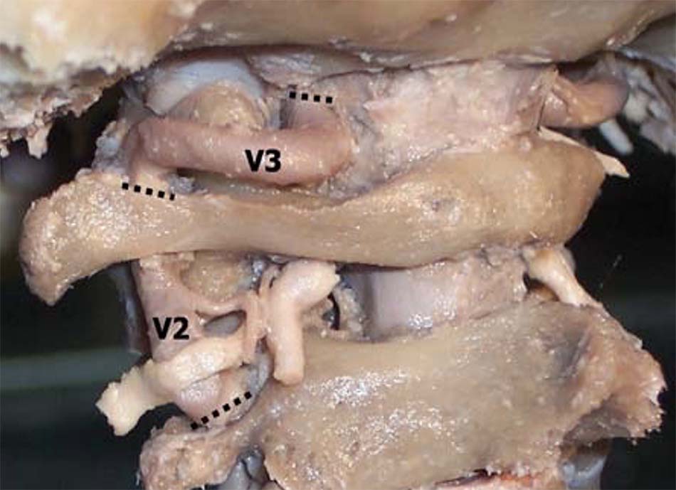 Phân đoạn ĐMĐS vùng C1 - C2 [54]