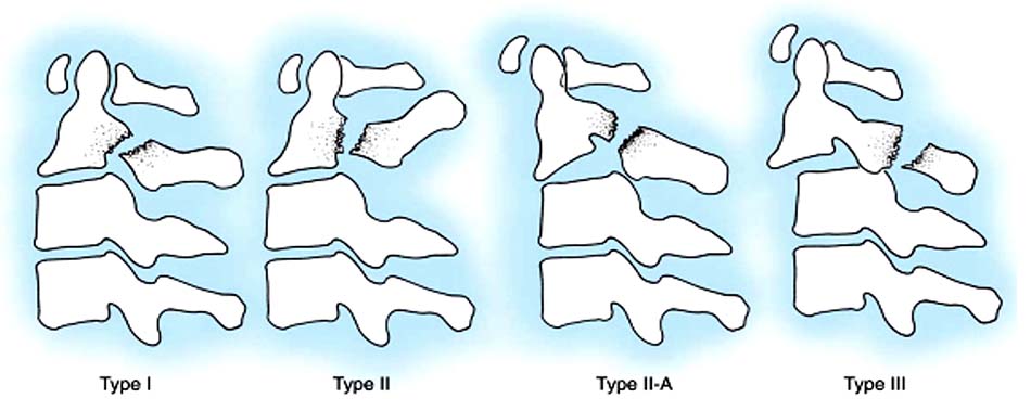 Phân loại gãy C2 (gãy Hangman)