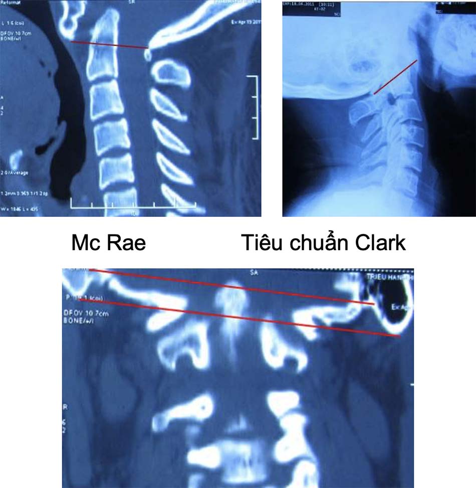 Các đường trong chẩn đoán tật lồng đáy sọ