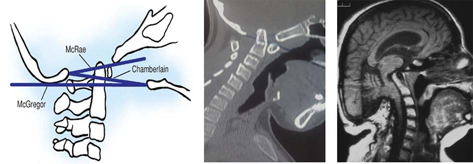 Tật lồng đáy sọ trên cắt lớp vi tính và cộng hưởng từ [1]