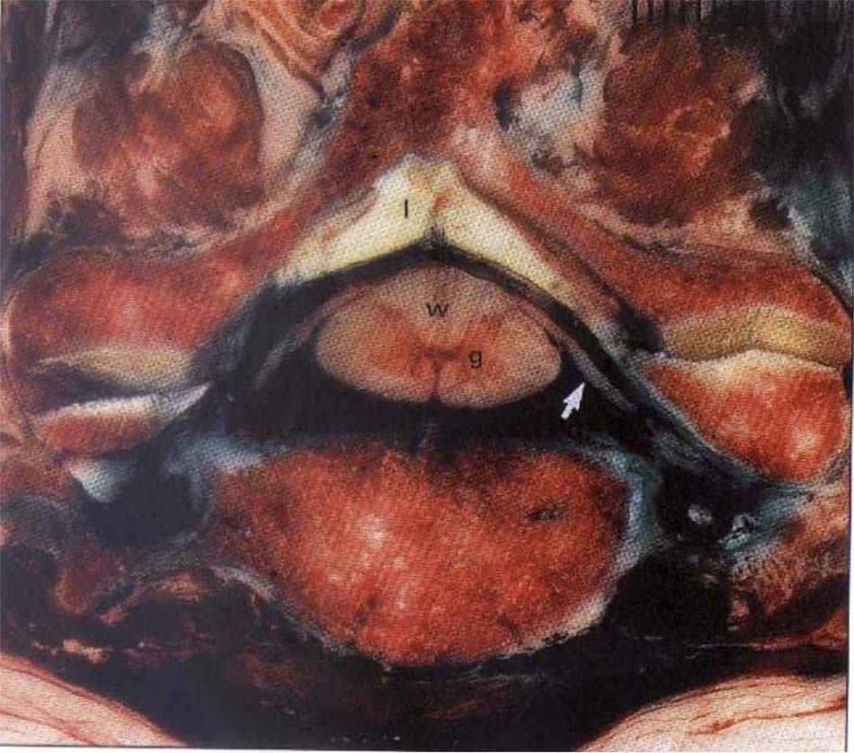 Thiết đồ cắt ngang tủy