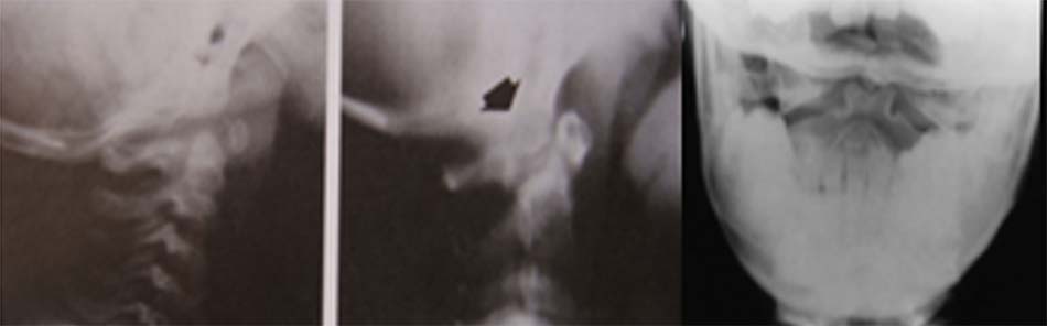 Thiểu sản mỏm nha trên Xquang