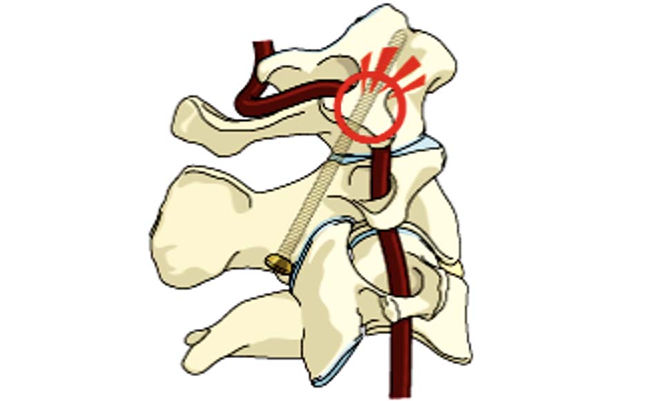 Minh họa nguy cơ cao tổn thương ĐMĐS khi vít qua khớp C1 - C2 ở bệnh nhân có ĐMĐS trèo cao