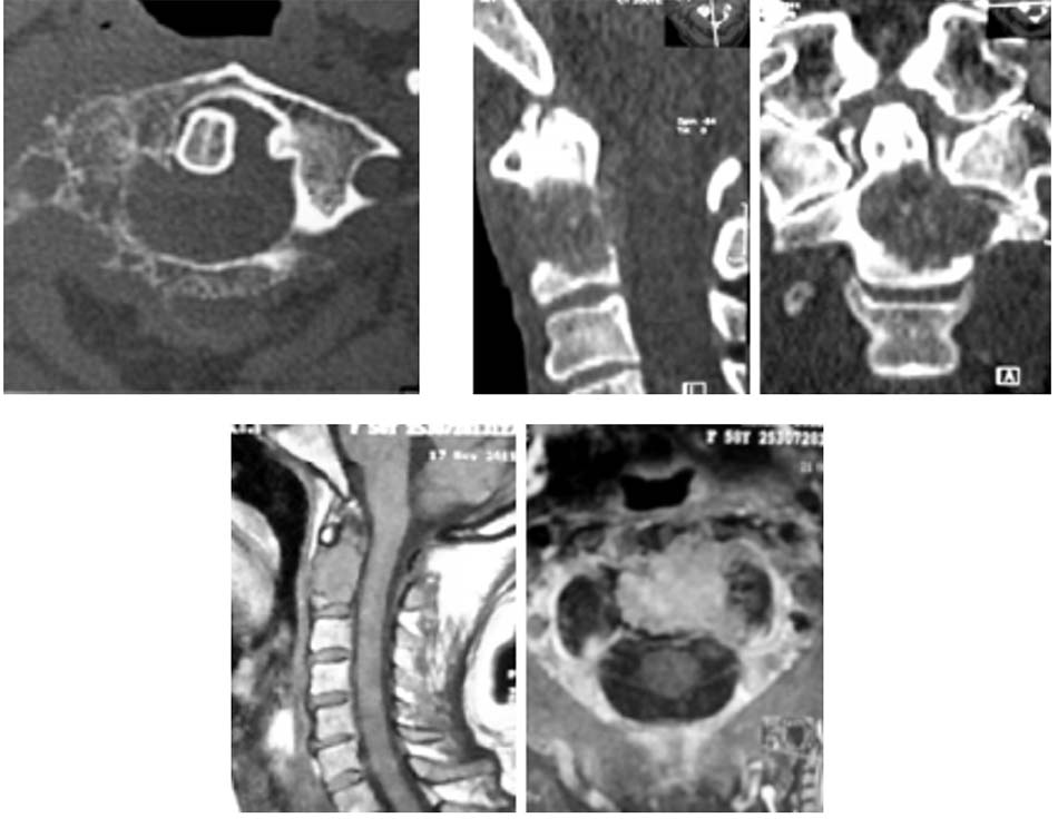 Tổn thương đốt sống C1 và C2 do khối u