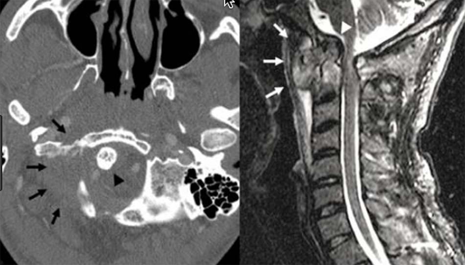 Tổn thương lao đốt sống C2 và phần mềm xung quanh