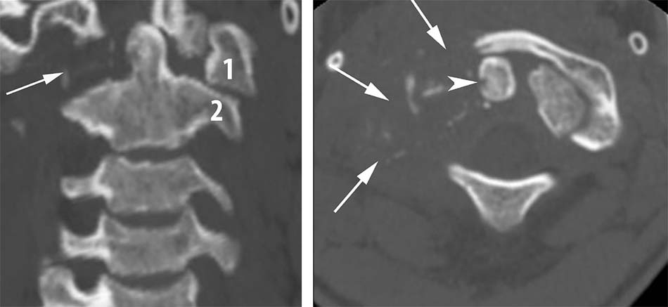 Tổn thương tiêu xương khối bên C1 (P)