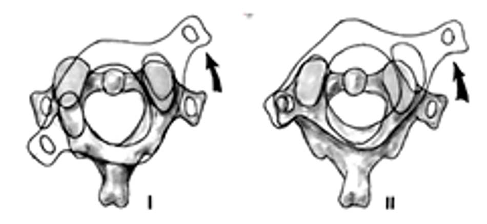 Trật C1-C2 loại 1 và 2