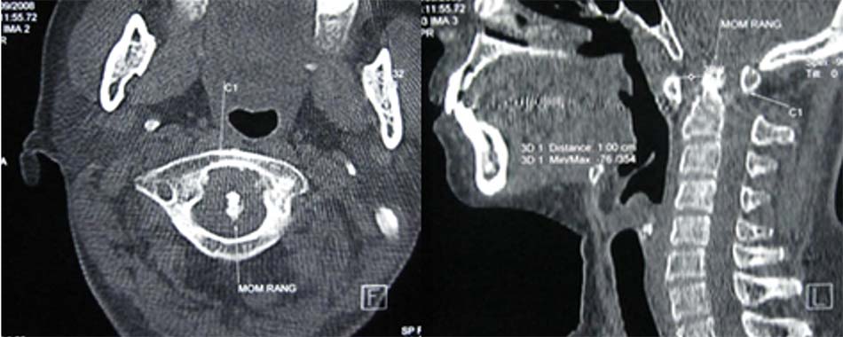 Trật C1-C2 do bệnh lý viêm khớp dạng thấp