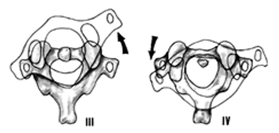 Trật C1-C2 loại 3 và 4