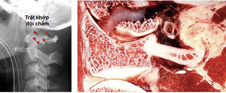 Trật chẩm - đội