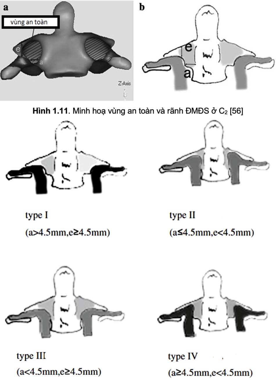 Các typ rãnh ĐMĐS đốt sống C2