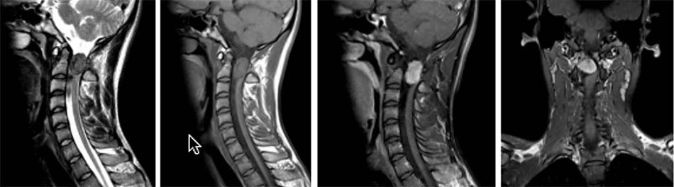 U trong ống sống C2 - ngoài tủy trên cộng hưởng từ