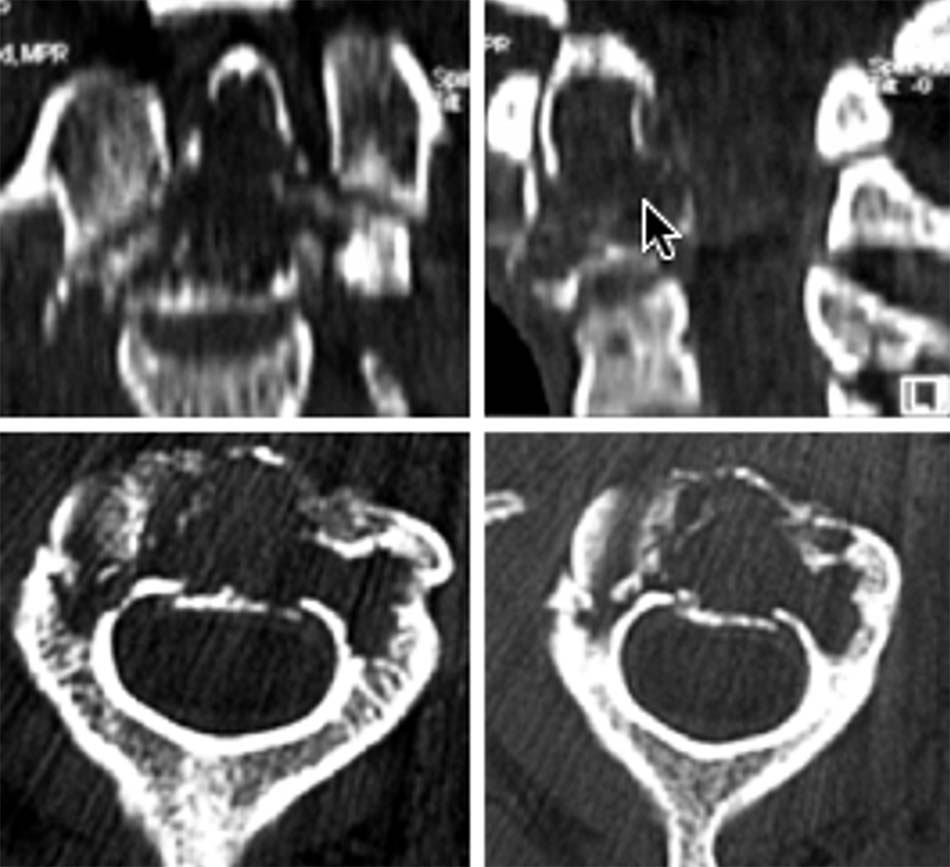 Tổn thương viêm tiêu đốt sống C2 và mỏm nha