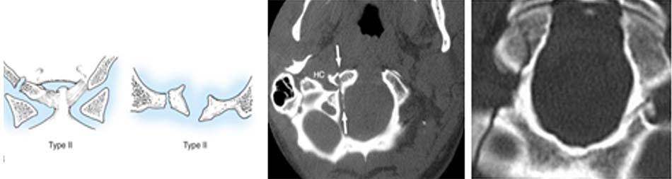Vỡ chỗ bám dây chằng cánh, tổn thương ít di lệch