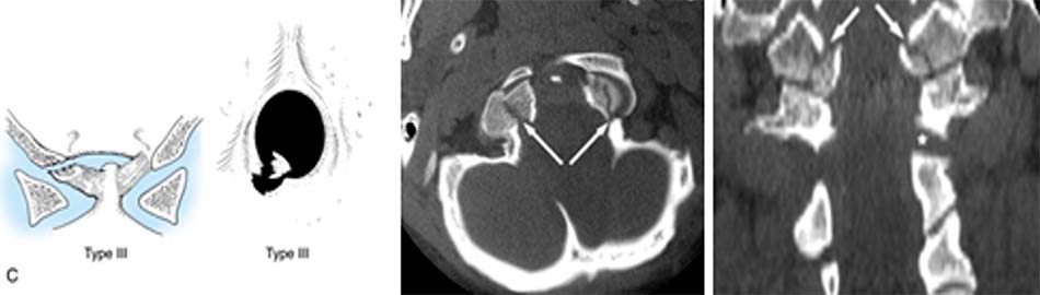 Vỡ chỗ bám dây chằng cánh, tổn thương có mảnh rời (loại 3)