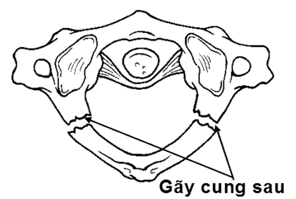 Hình ảnh vỡ cung sau C1 đơn thuần (loại 1)