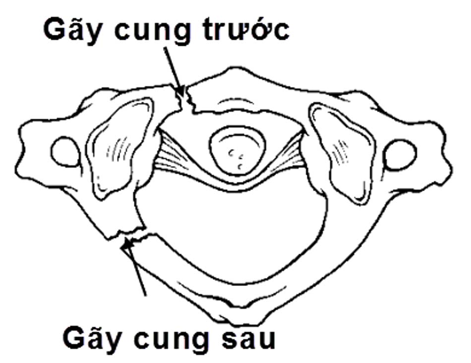 Hình ảnh vỡ cung sau C1 (loại 2)