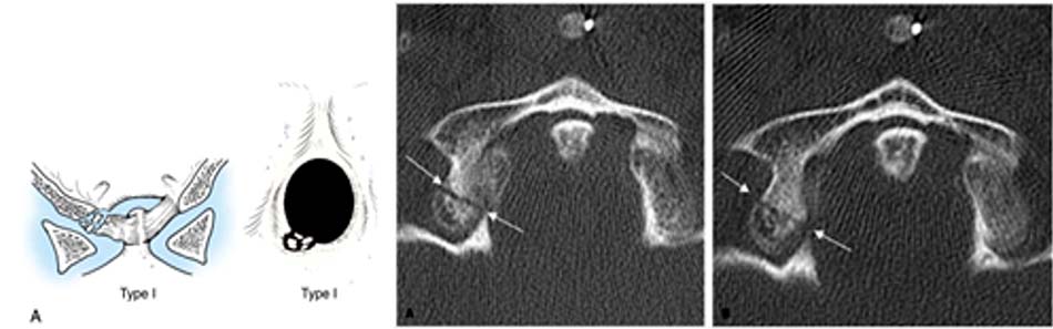 Vỡ vụn chỗ bám dây chằng cánh (loại 1)
