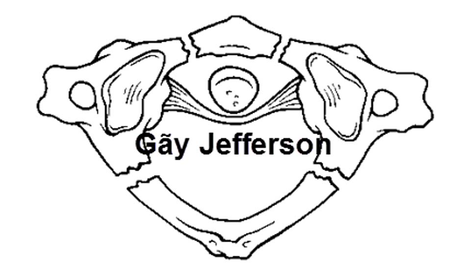 Hình ảnh vỡ vụn C1 - gãy Jefferson (loại 3)