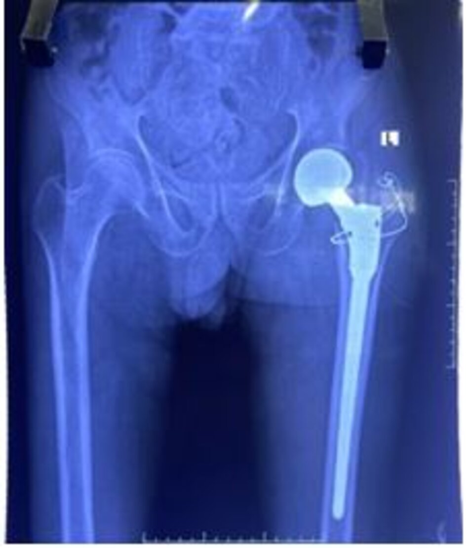 Xquang sau mổBệnh nhân được tập vận động khớp háng sau mổ, tập đi sau mổ 7 ngày