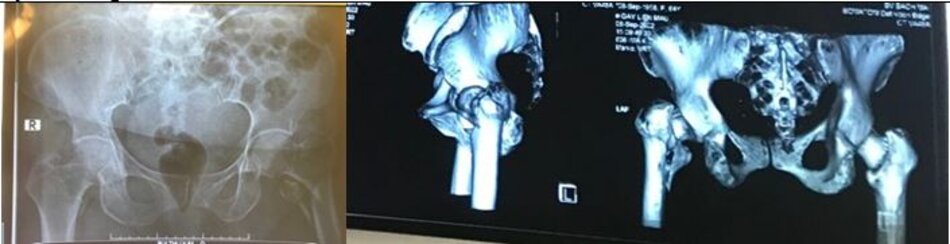 Phẫu thuật Đinh nội tuỷ Gamma