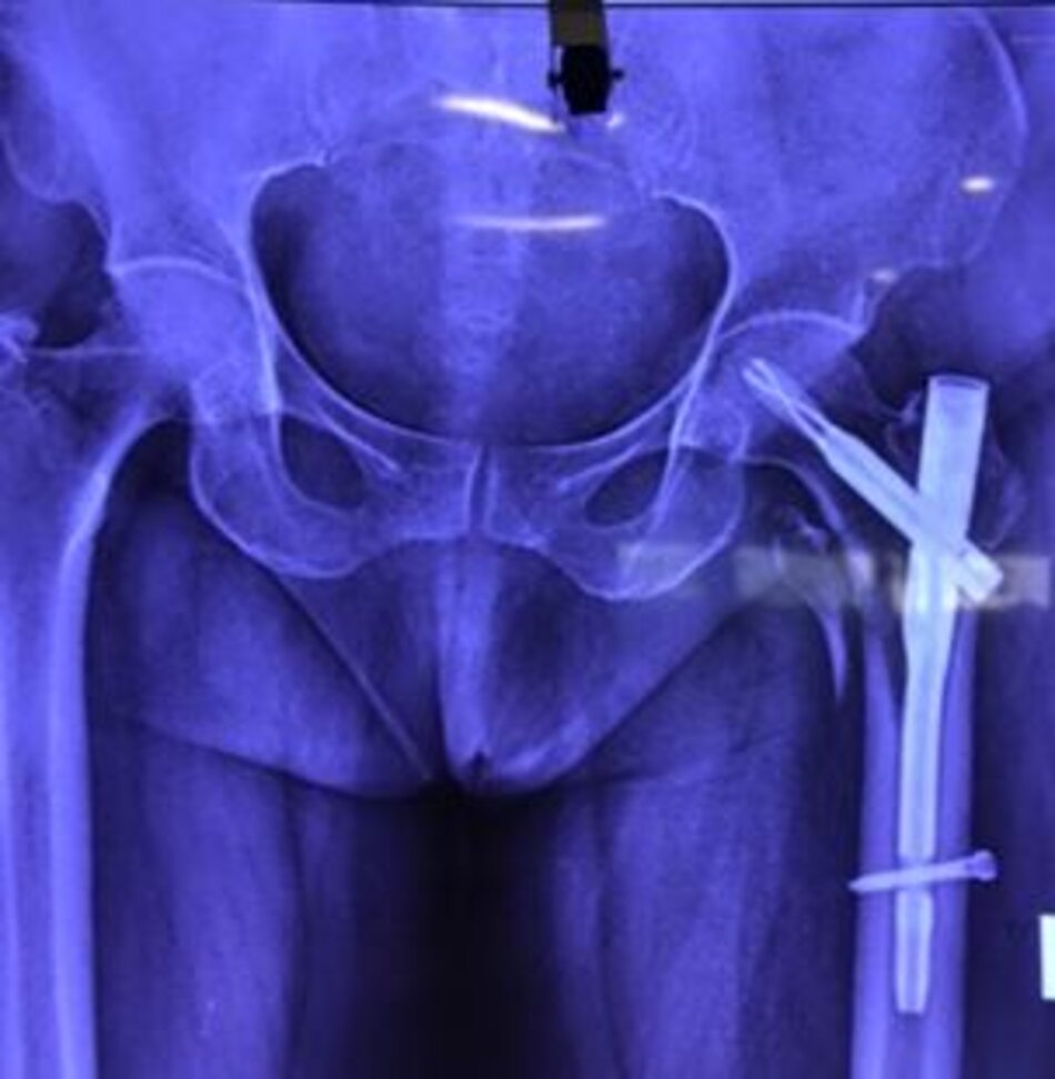 Phim Xquang sau mổ đóng đinh kín 