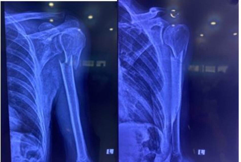 X-quang trước phẫu thuật trong tư thế thẳng và nghiêng