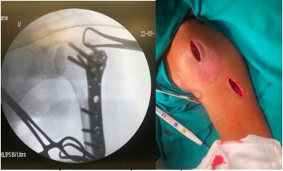 X-quang sau mổ và đường mổ ít xâm lấn với 2 đường rạch nhỏ