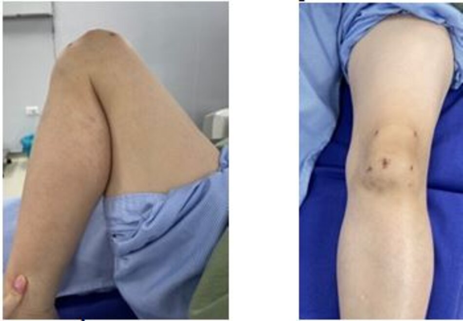 Vận động sau mổ hoàn toàn bình thường sau 1 năm phẫu thuật