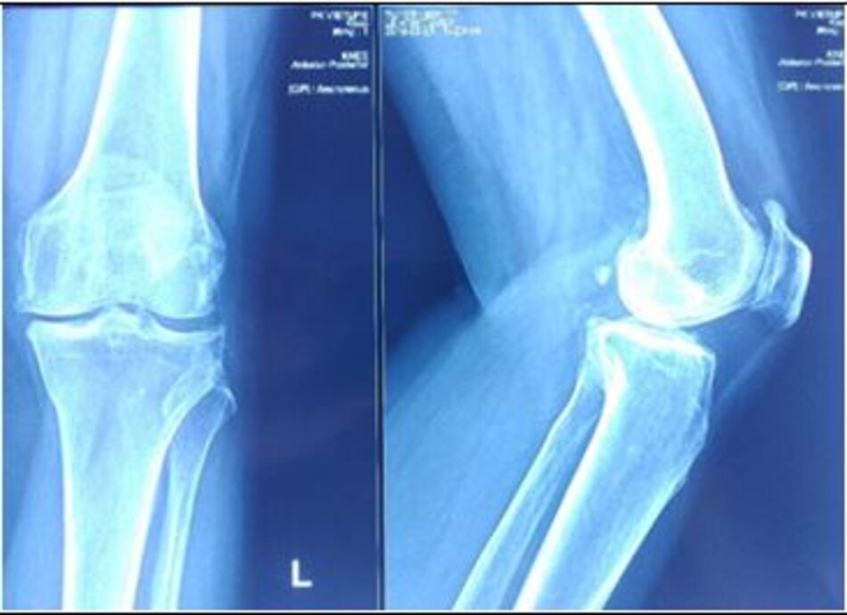 Xquang Khớp gối trái trước mổHình ảnh thoái hóa mâm chày trong
