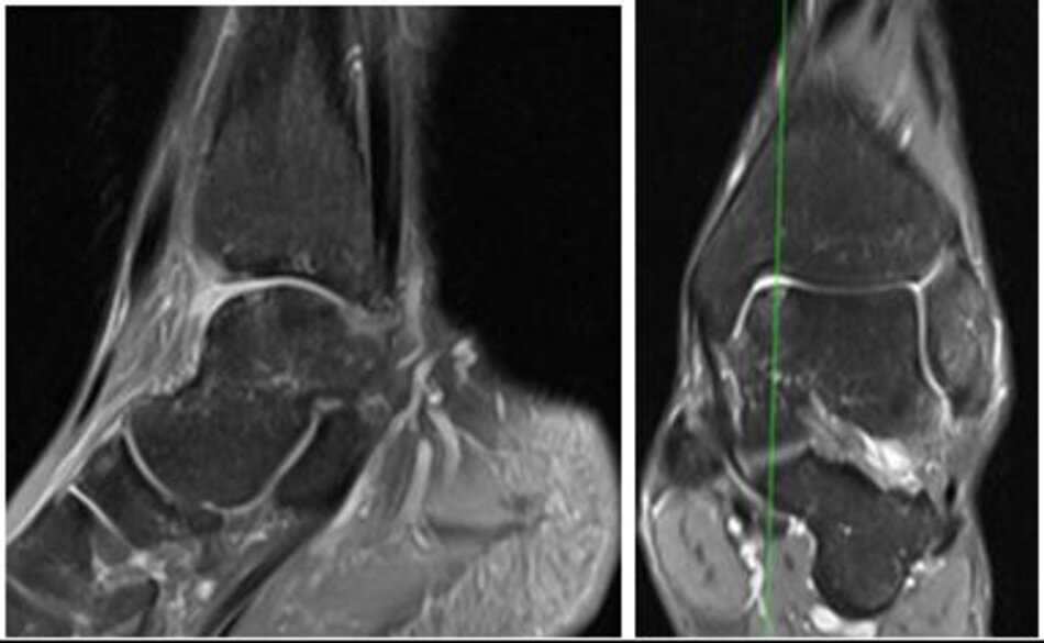 MRI sau mổ 6 tháng
