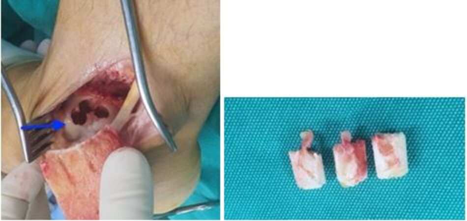 Lấy bỏ 3 khối xương sụn bị tổn thương, hình ảnh xương hoá mỡ trong 3 khối lấy bỏ