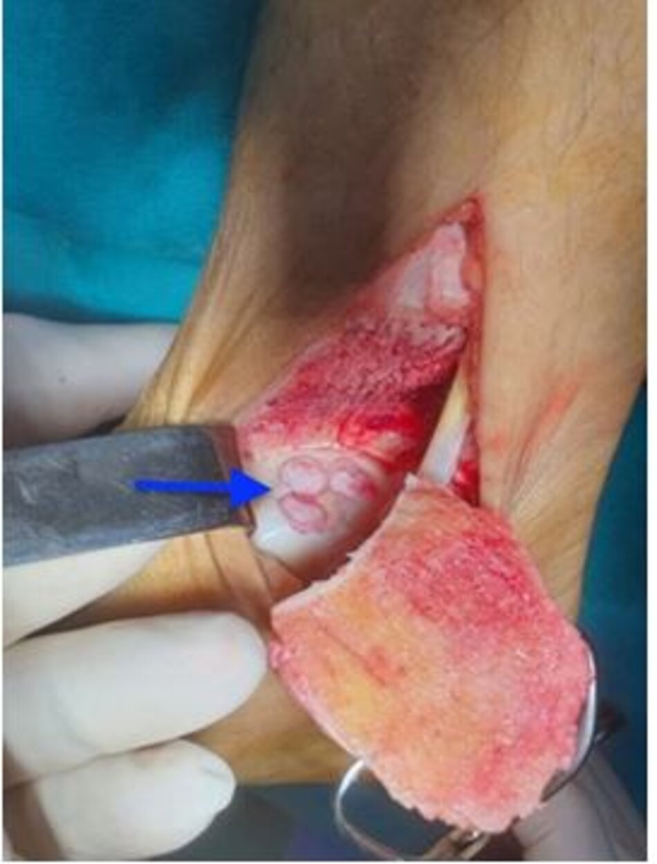 Sau khi lấy 3 khối tương ứng từ lồi cầu đùi ghép vào vị trí xương- sụn lóc tách xương sên