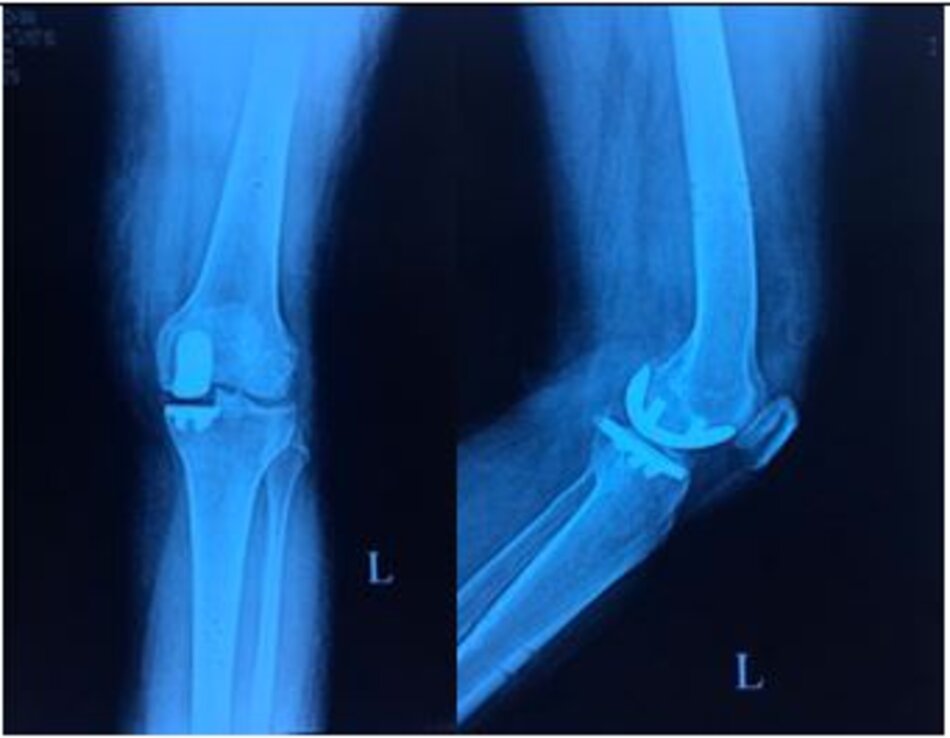 Xquang khớp gối trái sau mổ. Thay khớp gối bán phần có Robot hỗ trợ