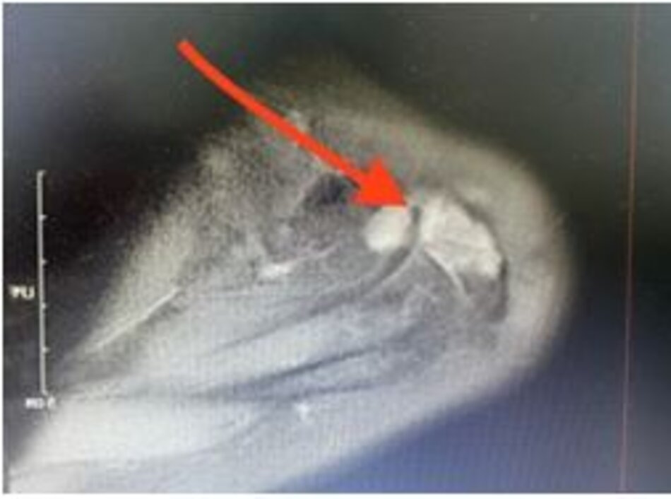 Rách gân trên gai trên phim chụp cộng hưởng từ và hình ảnh tương ứng qua nội soi khớp vai