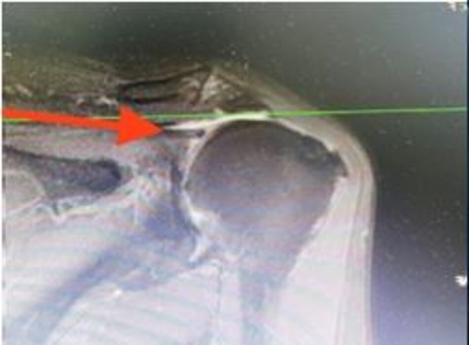 Gân trên gai sau khi được tạo hình khâu lại vào điểm bám cũ