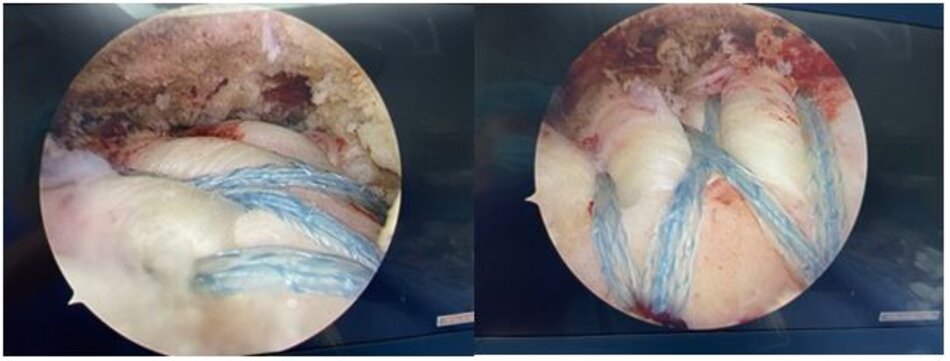 Gân trên gai sau khi được tạo hình khâu lại vào điểm bám cũ